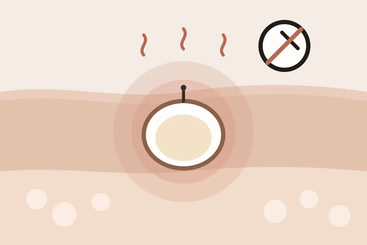 Illustration : coupe de peau montrant un kyste enflammé, avec un pictogramme « ne pas percer »